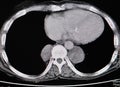 Lung CT