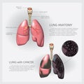 Lung with Detail and Lung Cancer