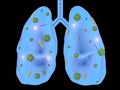 Lung disease with bacteria cells