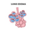 Lung edema illustration. Water collecting inside alveolar lumen