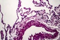 Lung emphysema, light micrograph