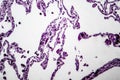 Lung emphysema, light micrograph