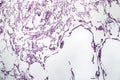 Lung emphysema, light micrograph