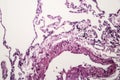 Lung emphysema, light micrograph