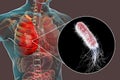 Lung infection caused by bacteria Pseudomonas aeruginosa