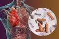 Lung infection caused by bacteria Pseudomonas aeruginosa