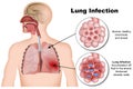 Lung infection pneumonia 3d medical illustration on white background
