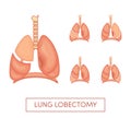 Lung lobectomy