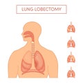 Lung lobectomy