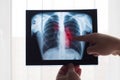 Lung radiography concept. Radiology doctor examining at chest x ray film of patient Lung Cancer or Pneumonia. Virus and Royalty Free Stock Photo