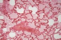 Lung tissue with pneumonia infection caused by flu Viral pneumonia under a microscope