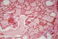 Lung tissue with pneumonia infection caused by flu Viral pneumonia under a microscope