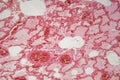 Lung tissue with pneumonia infection caused by flu Viral pneumonia under a microscope