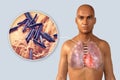 Lung tuberculosis and close-up view of bacteria Mycobacterium tuberculosis