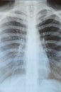 Lung x ray Royalty Free Stock Photo