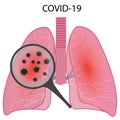 Lungs affected with coronavirus infection COVID19