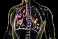 Lungs affected by cystic fibrosis, 3D illustration