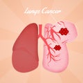 Lungs cancer