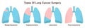 Lungs cancer surgery types. Wedge resection, segmentectomy
