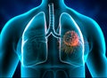 Lungs cancer