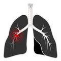 Lungs disease. Black lungs with bronchi on white background