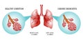 Lungs, the disease is bronchitis Royalty Free Stock Photo
