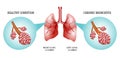 Lungs, the disease is bronchitis