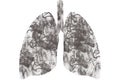 Lungs of a sick person smoker. Lungs` cancer. Health problems