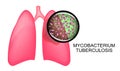 LUNGS OF TB PATIENTS. KOHA