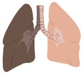 Lungs and trachea cancer