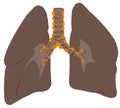 Lungs and trachea cancer