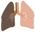 Lungs and trachea cancer