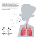 Mucormycosis black fungus infection in the lungs through inhaled spores