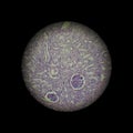 Lupus nephritis