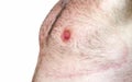 Lyme borreliosis - erythema migrans Royalty Free Stock Photo