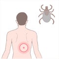 Lyme disease, Borreliosis or Borrelia Royalty Free Stock Photo