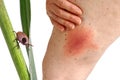 Lyme disease caused by a tick bite on the thigh.