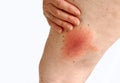 Lyme disease caused by a tick bite on the thigh. Royalty Free Stock Photo