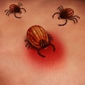 Lyme Disease Human Tick Royalty Free Stock Photo