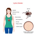 Lyme disease. Woman with erythema, signs and symptoms Lyme borreliosis.