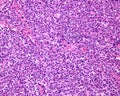 Lymph node. Reticulosarcoma