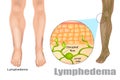 Lymphedema, also known as lymphoedema