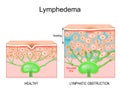 Lymphedema. Cross section of a human skin