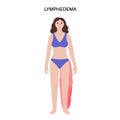 Lymphedema leg swelling