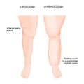 Lymphedema and Lipoedema. Comparison and difference. Overweight problem Royalty Free Stock Photo