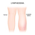 Lymphedema. lymphoedema. Healthy leg, and lymphatic edema