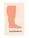 Lymphedema stages