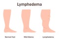 Lymphedema stages. Lymphatic system dysfunction disease. Swollen legs,