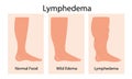 Lymphedema stages.