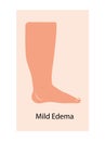 Lymphedema stages.v